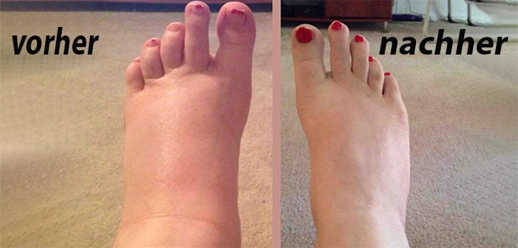 before and after using Comprex compression socks