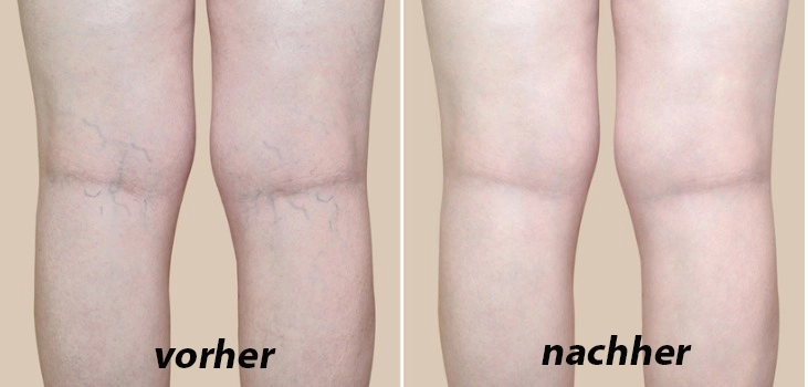 before and after using Comprex compression socks